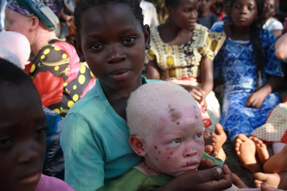 June 13 – International Albinism Awareness Day