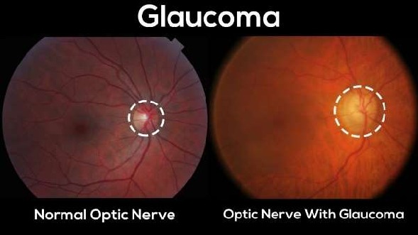 World Glaucoma Week: 9-15 March 2025